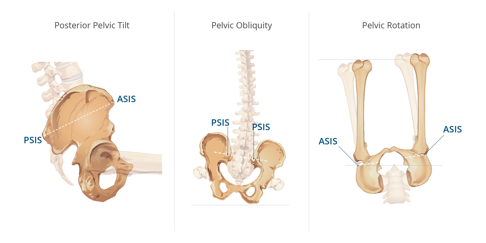 Cushion Considerations: Providing the Required Postural Support