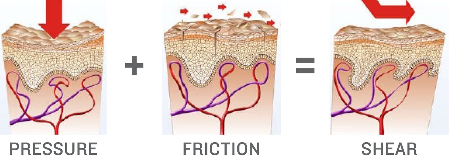 Shear Skin Example Shear reduction: An important element in pressure injury prevention