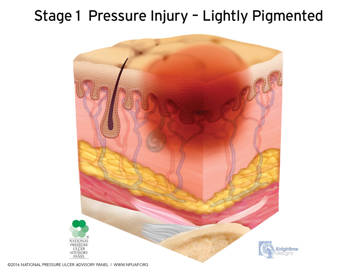 Sheering Injuries Pathway of Wounds: Shear vs Pressure