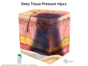 Pathway of Wounds: Shear vs Pressure