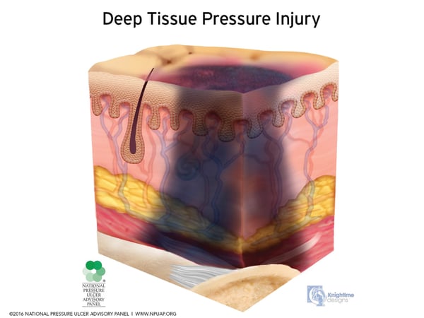 Deep-Tissue-Pressure-Injury-April-2016