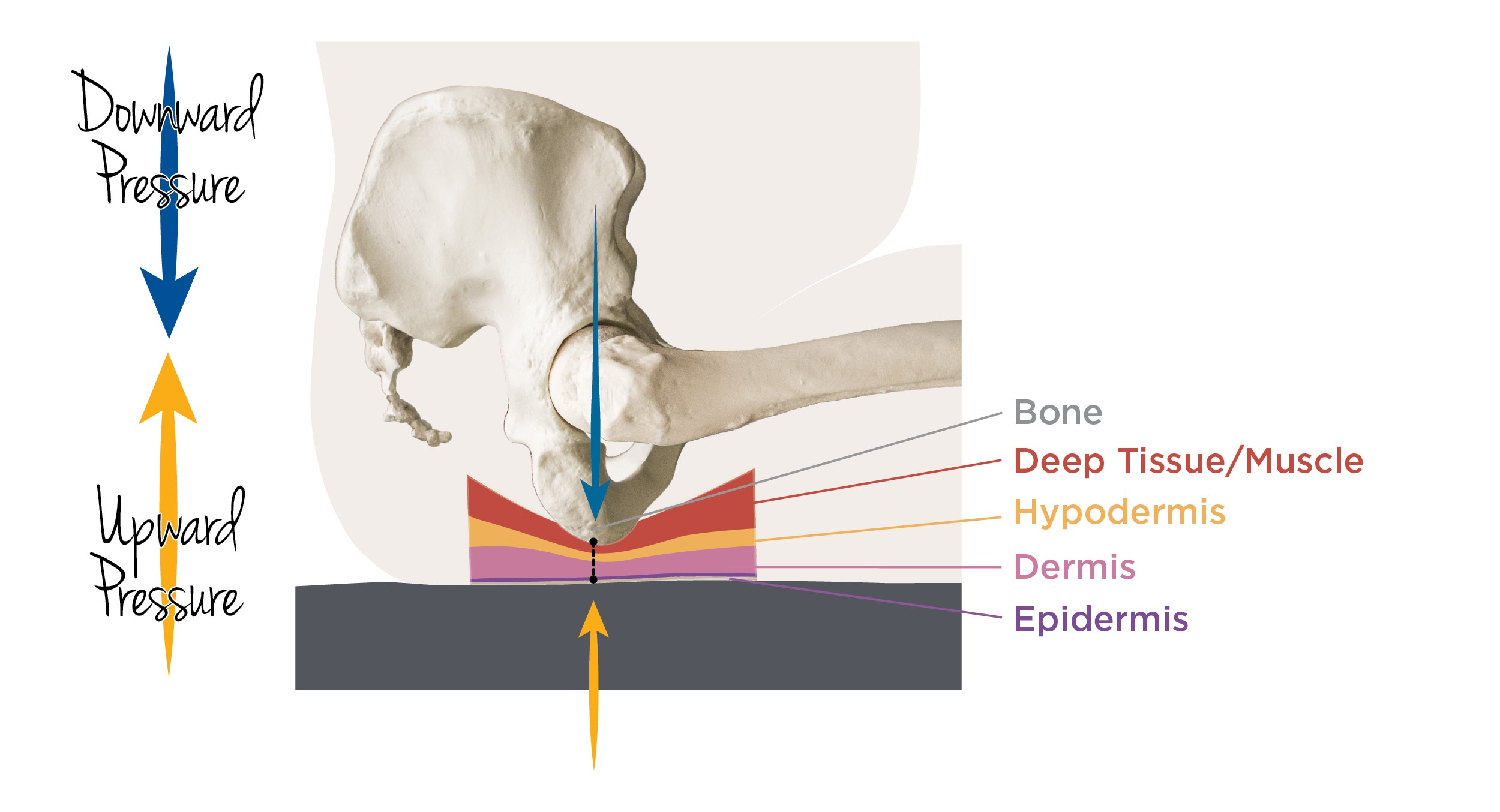 Pressure_injury_Stages_in_the_seated_position