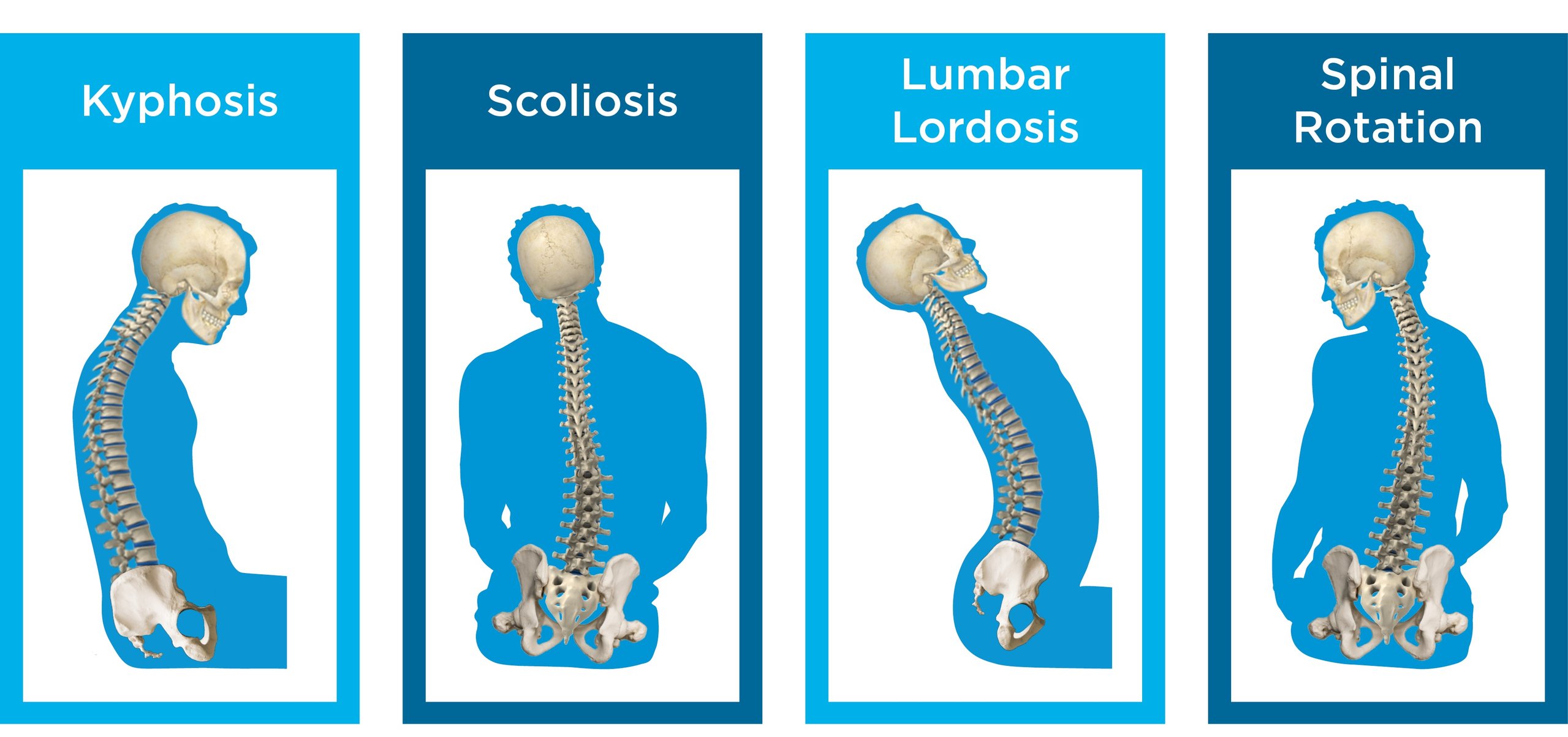 Kyphosis, Lordosis, Scoliosis, Spinal Rotation.