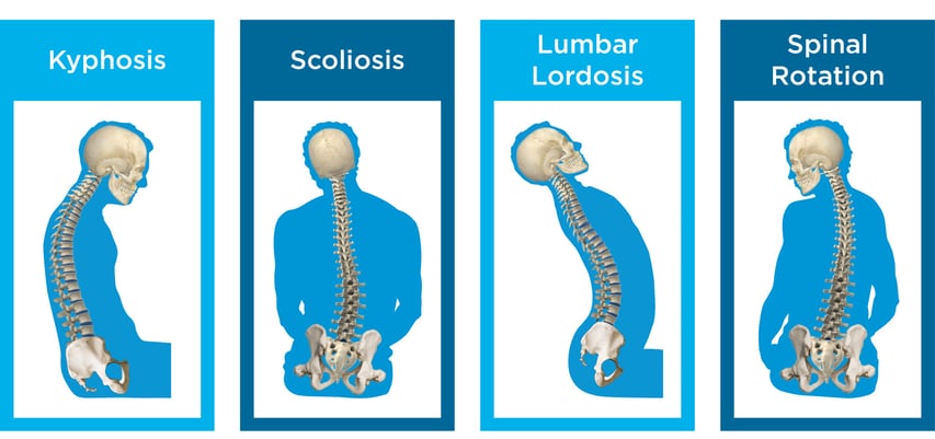 Kyphosis, Lordosis, Scoliosis, Spinal Rotation
