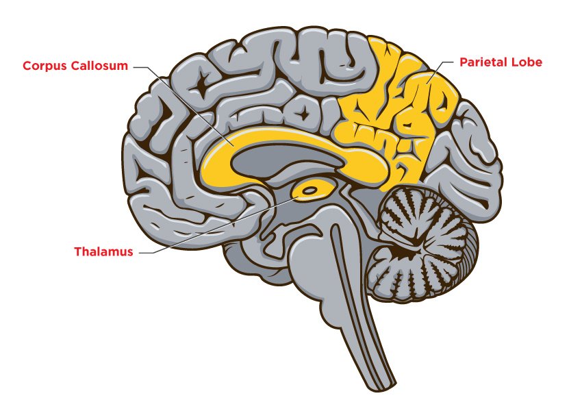 Dementia-Brain-No5.jpg