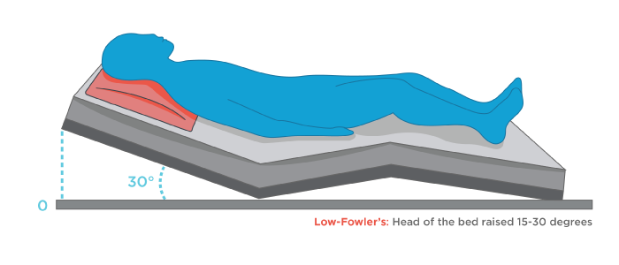 Fowler’s Position: Beyond The Bed