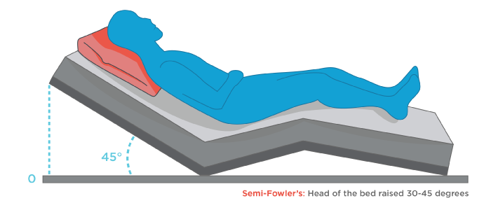 Fowler’s Position: Beyond the Bed