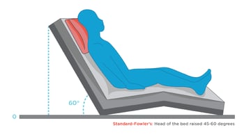 Fowler’s Position: Beyond the Bed