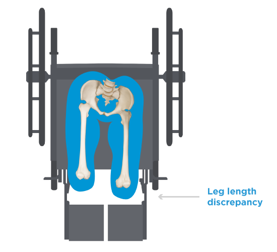 Pelvic-Rotation-Leg-Length.png