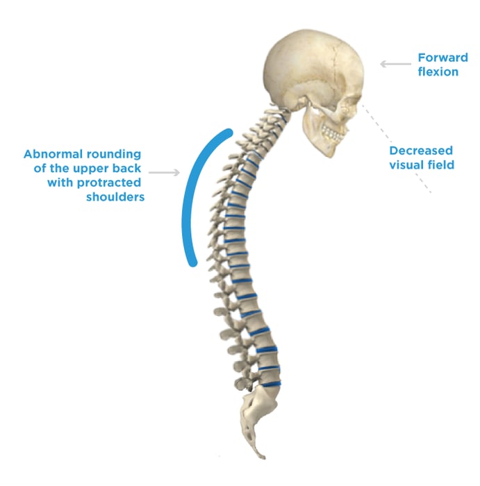 Posterior-Pelvic-Tilt_Kyphosis.png