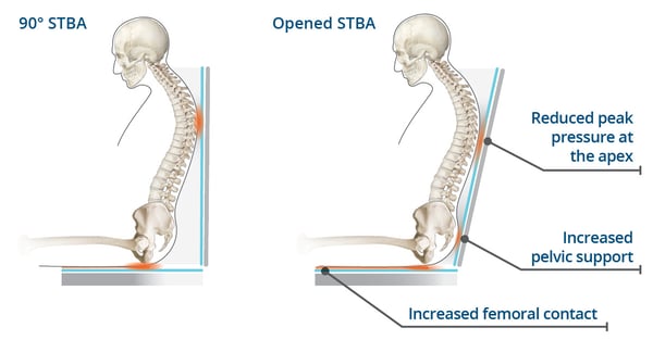 90 vs open STBA