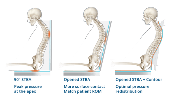 Adjustability STBA