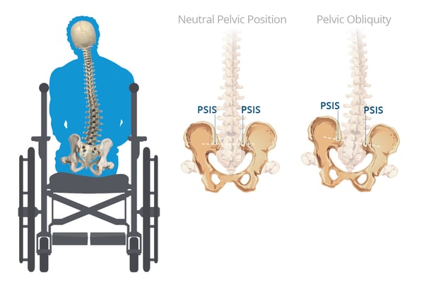 Pelvic Obliquity: Definition, Symptoms and Solutions