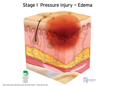 Stages-of-pressure-injuries-Stage-1