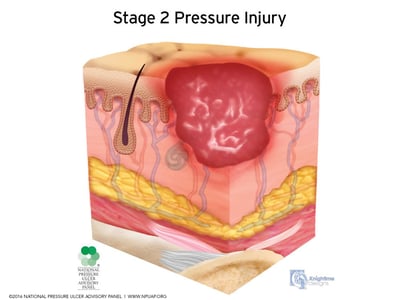 Stages-of-pressure-injuries-Stage-2