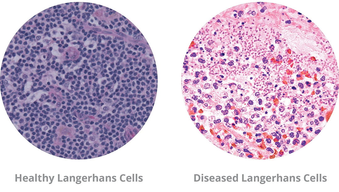Langerhans Cells