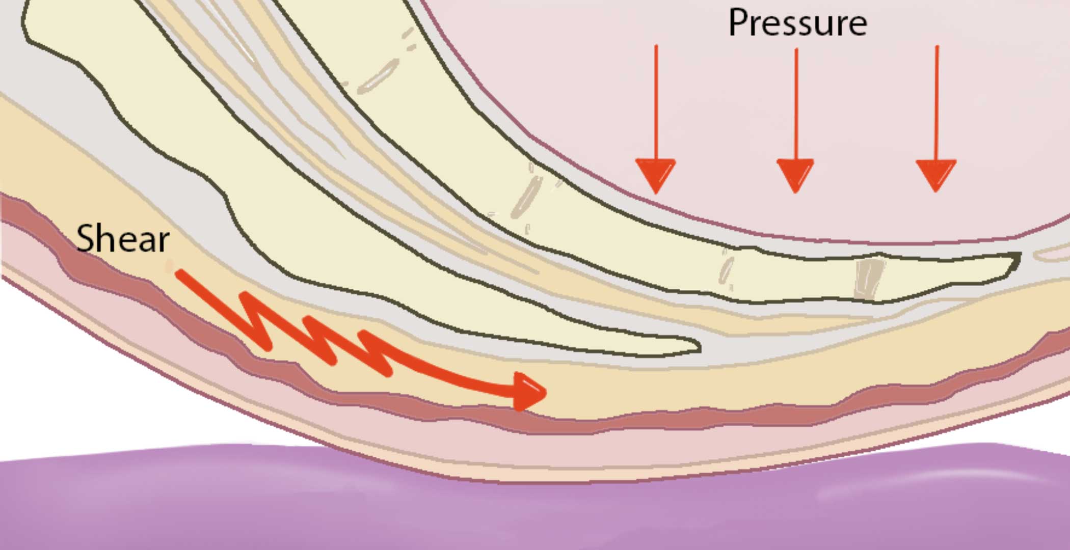 Shear reduction: An important element in pressure injury prevention
