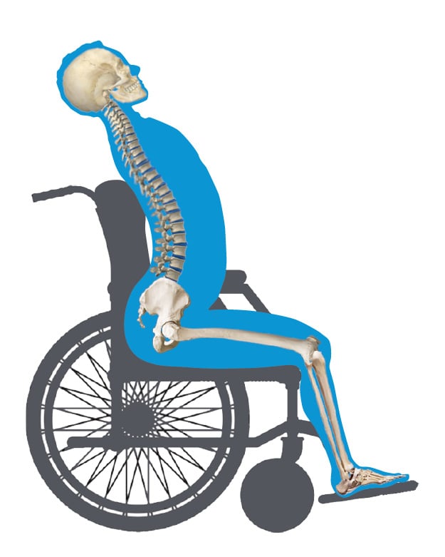 Anterior Pelvic Tilt Wheelchair View