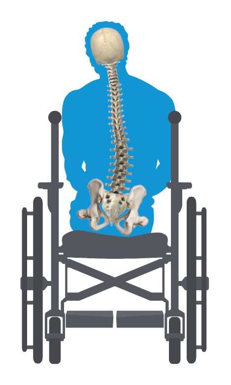 Pelvic Obliquity Wheelchair View